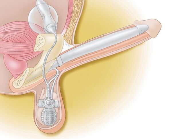 prosthetic penis enlargement