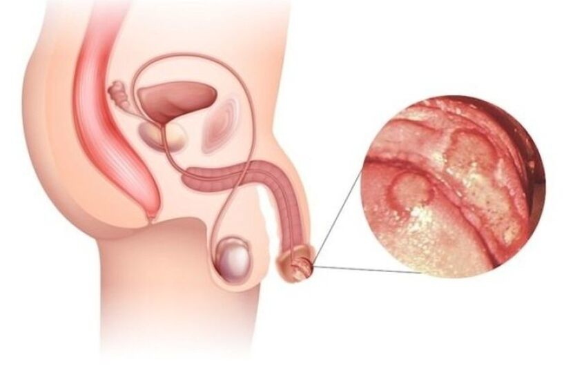 enlargement of a small penis and glans